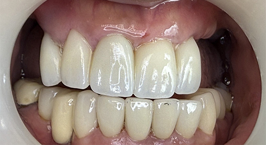 Up-close photo of mouth After Transformation