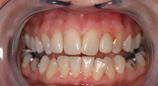 Up-close photo of mouth After Transformation