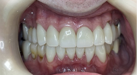 Up-close photo of mouth After Transformation