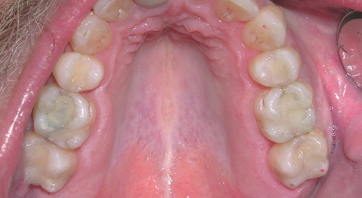 Up-close photo of mouth After Transformation