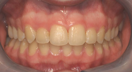 Up-close photo of mouth After Transformation