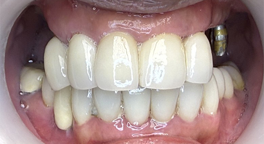 Up-close photo of mouth BeforeTransformation