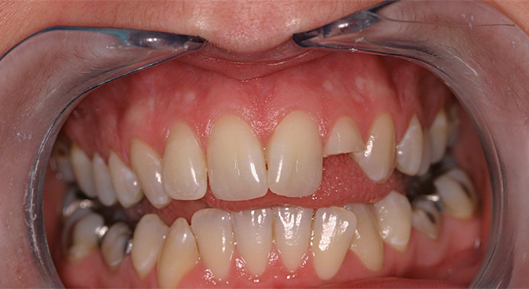 Up-close photo of mouth BeforeTransformation