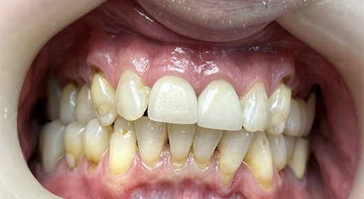 Up-close photo of mouth BeforeTransformation
