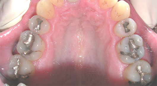 Up-close photo of mouth Before Transformation