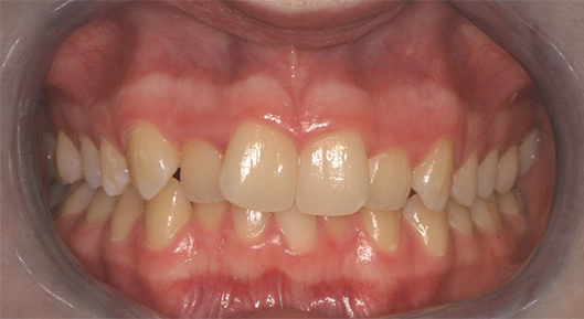 Up-close photo of mouth Before Transformation